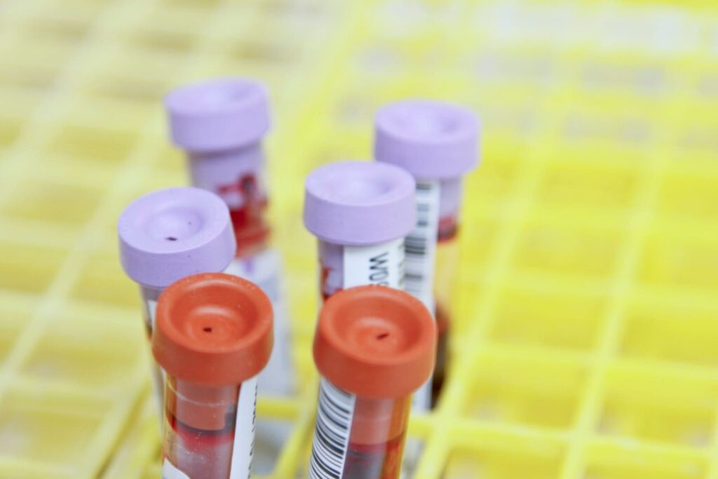 Tray of blood collection tubes in a clinic, illustrating a syphilis blood test