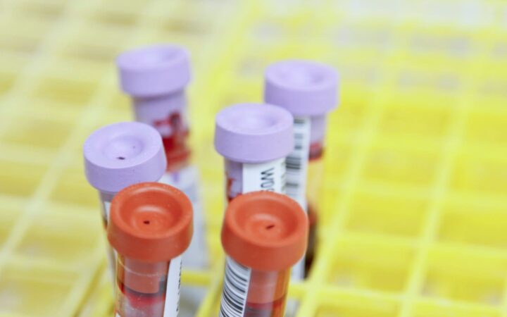 Tray of blood collection tubes in a clinic, illustrating a syphilis blood test
