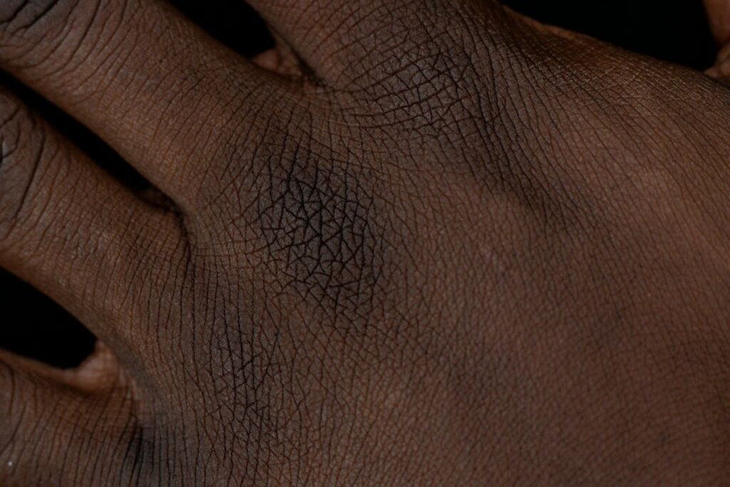 Close view of a hand, where the rash of secondary syphilis often appears on the palms